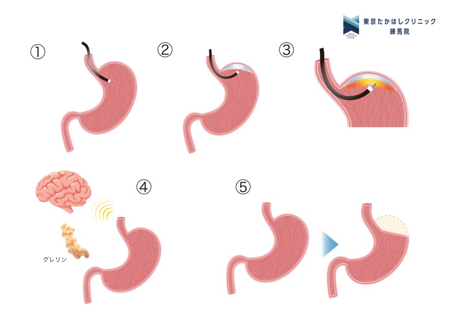 胃粘膜アブレーション